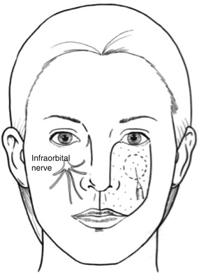 Fig 14 Infrorbital nerve block Landmark Zygomaticofacial nerve emerges - photo 4