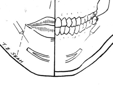 Fig 16 Mental nerve block Landmark Mental Nerve Emerges from the - photo 6