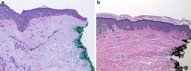 Fig 11 Microscopic evaluation of peripheral margins a Melanoma in situ - photo 1