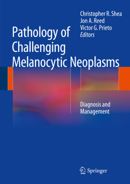 Christopher R. Shea Pathology of Challenging Melanocytic Neoplasms: Diagnosis and Management