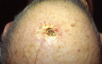 Fig 11 A keratotic nodule with erythematous halo on the scalp of an old - photo 1