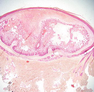 Fig 12 A squamous tumor extending into the dermis with pseudoglandular spaces - photo 2