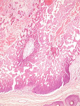 Fig 13 Pseudovascular or pseudoglandular appearance due to tumor cell - photo 3