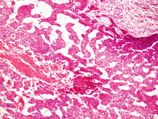 Fig 15 The epithelial cells are atypical with bright eosinophilic focally - photo 5