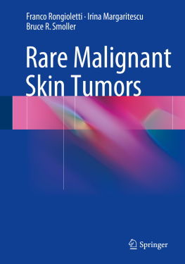 Franco Rongioletti - Rare Malignant Skin Tumors