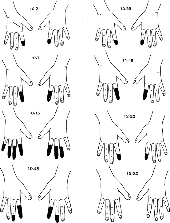 Fig 14 Temporal sequence of a symmetric attack of Raynauds phenomenon The - photo 4