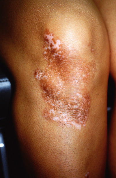 Fig 110 Vitiligo of the right knee in a Hispanic female with repigmentation - photo 10