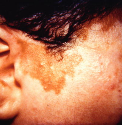 Fig 111 Vitiligo of the right cheek in an African American female before - photo 11