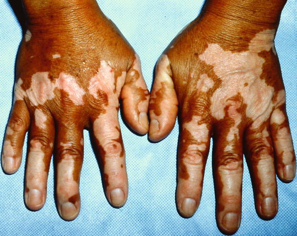 Fig 11 Bilateral vitiligo in a Hispanic male Fig 12 Vitiligo of the - photo 1