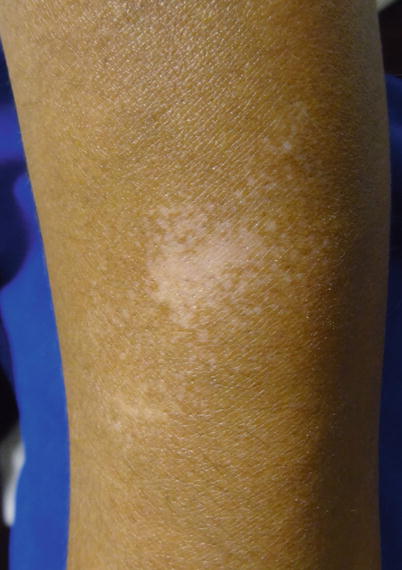 Fig 12 Vitiligo of the forearm in a Hispanic female Fig 13 Vitiligo - photo 2