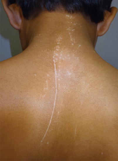 Fig 13 Vitiligo of the back in a South Asian boy demonstrating the Koebner - photo 3