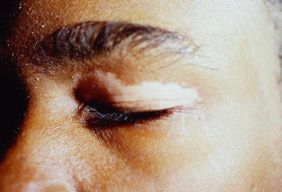 Fig 16 Segmental vitiligo of the left upper eyelid in an African American - photo 6