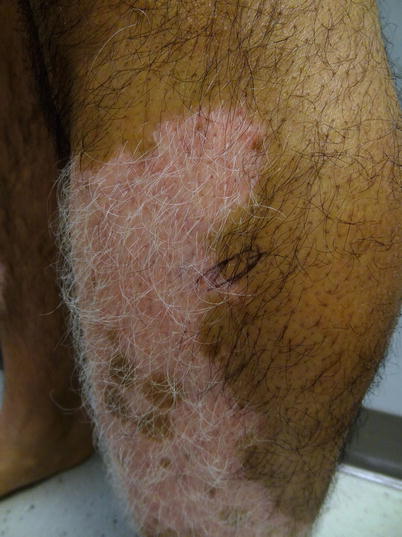 Fig 18 Leukotrichia in a patch of vitiligo in a Hispanic male Fig 19 - photo 8
