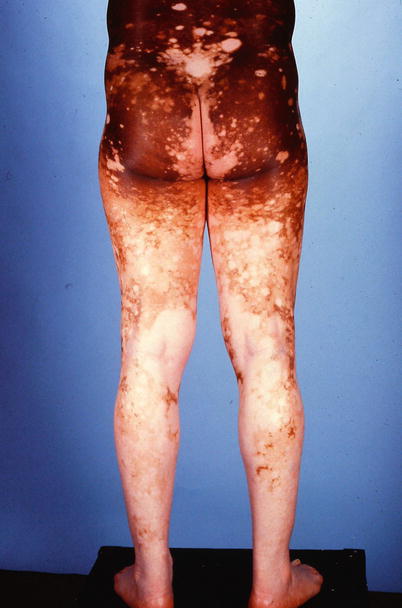 Fig 19 Severe bilateral vitiligo in an African American male 13 - photo 9