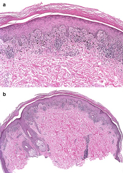 Fig 11 a There is a lichenoid lymphocytic infiltrate with saw-toothed - photo 1