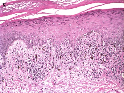 Fig 11 a There is a lichenoid lymphocytic infiltrate with saw-toothed - photo 2