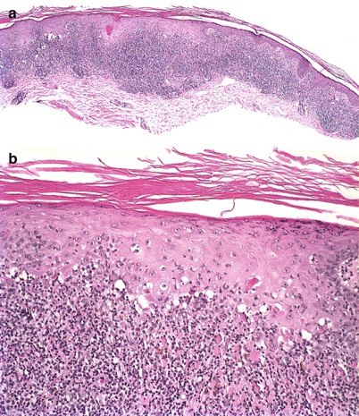 Fig 12 a A lichenoid keratosis has a lichenoid lymphocytic infiltrate - photo 3