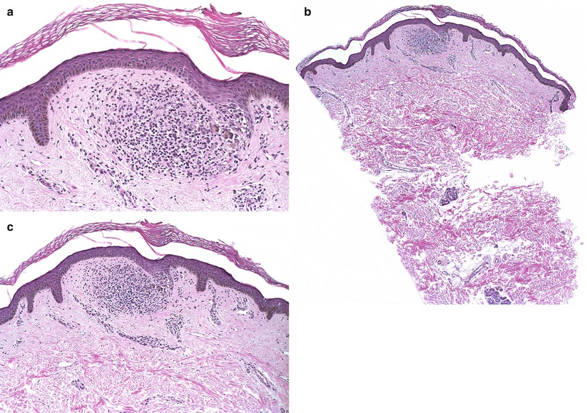 Fig 14 a The epidermal retia are beginning to extend around the - photo 5