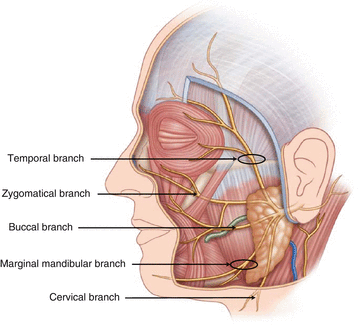 Figure 15 Branches of the facial nerve circles indicate areas at greatest - photo 5