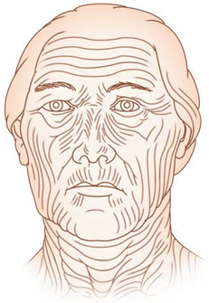 Figure 112 Skin tension lines face for planning optimal incisions to - photo 12