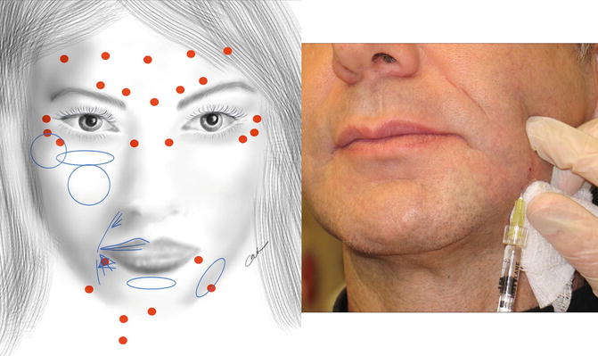 Fig 13 Common sites for facial botox red and dermal filler blue - photo 3