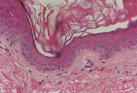 Fig 11 Epidermal melanocytes Solitary cells with pale cytoplasm and round or - photo 1