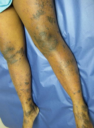 Fig 12 A 10-year-old female with very lichenified plaques due to chronic - photo 2