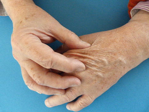 Fig 11 The skin of the dorsum of the hand is thin soft and pliable Some - photo 1