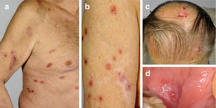 Figure 11 a Excoriations postinflammatory hypopigmentations and atrophic - photo 1