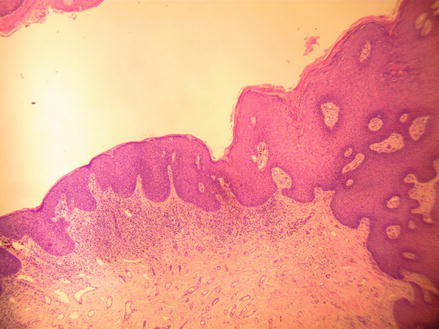 Figure 12 HE 40 Bowenoid papulosis on the left while condyloma acuminata is - photo 2