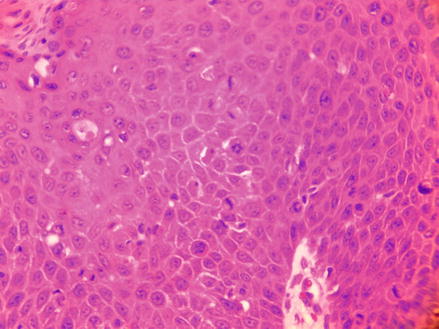 Figure 14 HE 400 Bowenoid papulosis showing multiple mitotic figures - photo 4