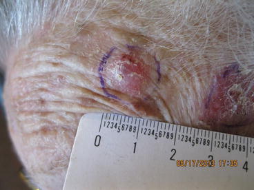 Figure 21 Merkel cell carcinoma Clinical Differential Diagnosis Raised - photo 5