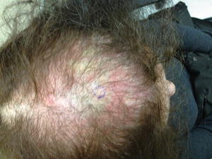 Figure 11 Diffuse hair loss as can been seen in advanced telogen effluvium - photo 1