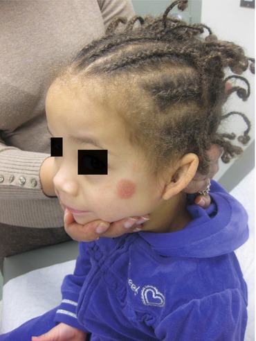 Fig 110 Atopic dermatitis nummular mild On this childs face is a - photo 10