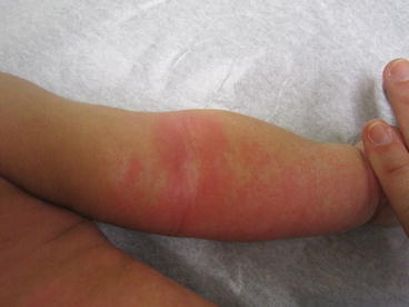 Fig 112 Atopic dermatitis nummular generalized On this childs arm and - photo 12