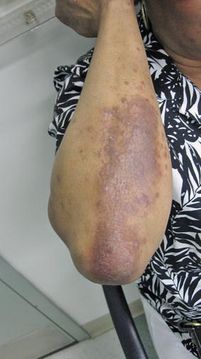 Fig 115 Lichen planuslike atopic dermatitis more extensive A large - photo 15