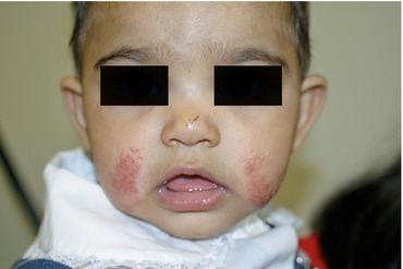 Fig 11 Atopic dermatitis facial-extensor In this infant there are crusted - photo 1