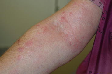 Fig 17 Atopic dermatitis flexural severe On this antecubital fossa there - photo 7