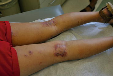 Fig 19 Atopic dermatitis flexural severe and impetiginized On the - photo 9