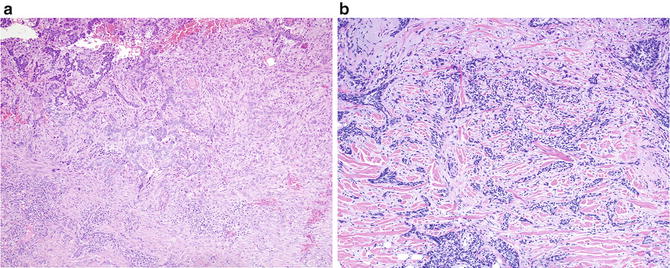 Fig 11 a This is an example of infiltrative BCC In small or in limited - photo 1