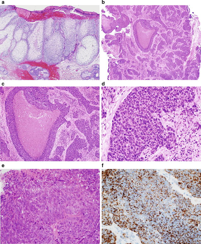 Fig 12 a This is an example of a low grade sebaceous carcinoma These - photo 2