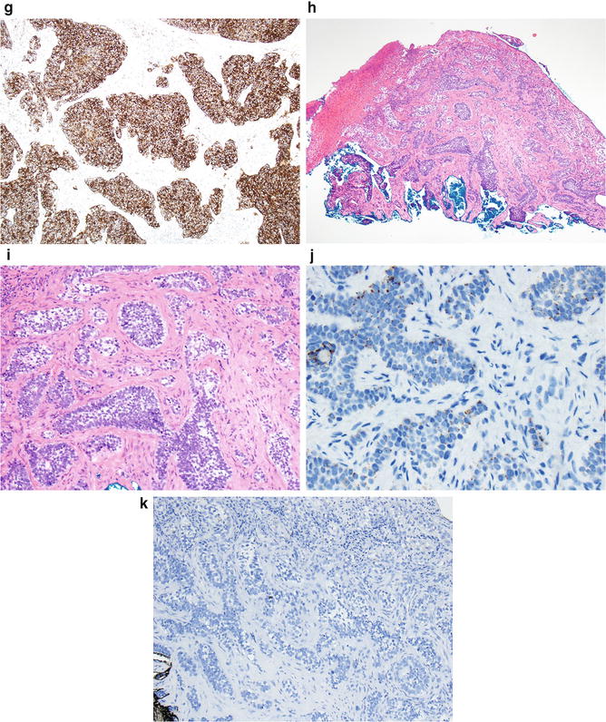 Fig 12 a This is an example of a low grade sebaceous carcinoma These - photo 3