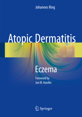 Johannes Ring Atopic Dermatitis: Eczema