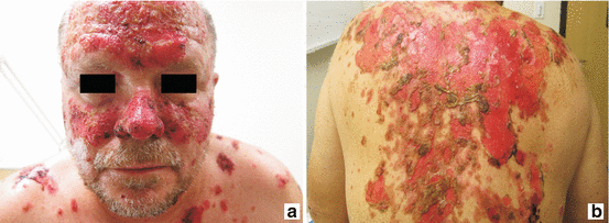 Fig 11 Clinical features of pemphigus vulgaris Flaccid blisters erosions - photo 1