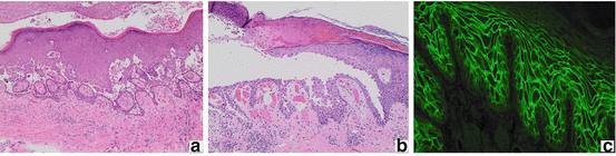 Fig 12 Immunohistology of pemphigus vulgaris Suprabasilar clefting blister - photo 2