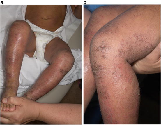 Fig 11 a b A 4-year-old child with flare of moderate atopic - photo 1