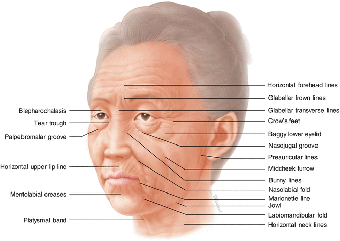 Fig 11 Aging facial creases and wrinkles Published with kind permission of - photo 2