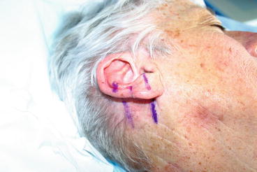 Figure 12 Ear interpolation flap plan The Technique The mastoid - photo 2