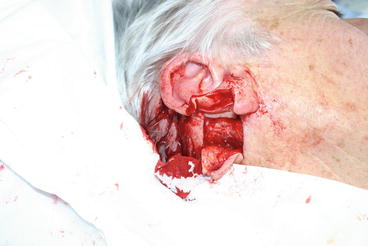 Figure 13 Ear mastoid interpolation flap being raised Even with such - photo 3