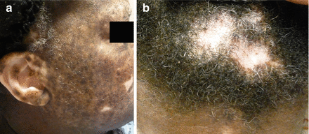 Figure 11 a b Discoid lupus of the scalp and face Polymorphic round to - photo 1